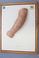 Moulage, Impferythem (Arm), 33,5x25,5 cm