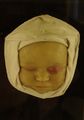 Moulage, Conjunctivitis gonorrh. neonat. / Blennorrhoea neonatalis (Gesicht/Auge) [Kolbow], 15,5x21,5x5 cm