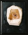 Moulage, Normale Augenlider umgedreht (linkes Auge), 16x20,5x5 cm