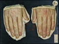 Moulage, Beau'sche Linien der Nägel (Hände) [Leonhardt]