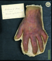 Moulage, Leukämie mit Carcinom (Hand) [Leonhardt]